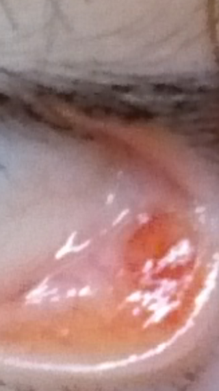 目の中にニキビのような赤いできものが出来ました 一回白い膿みたいな Yahoo 知恵袋