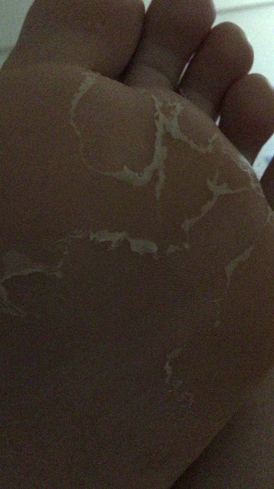 水虫 解決済みの質問 Yahoo 知恵袋