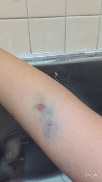 私は生まれつき写真の通り右腕と右胸の上に青い血管がハッキリ浮き出て Yahoo 知恵袋