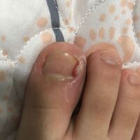 閲覧注意です 最初は足の指と爪の間から黄色い汁が出てきて軟膏を塗り絆創 Yahoo 知恵袋