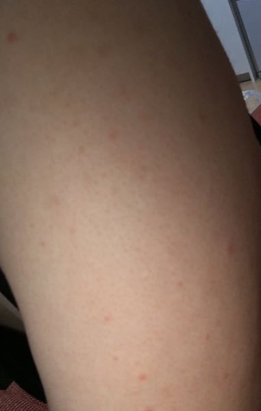 この二の腕のぶつぶつはなんでしょうか かゆみも少しあります Yahoo 知恵袋