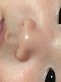 赤ちゃんのニキビ跡について 生後3ヶ月の子の顔に ニキビ跡らし Yahoo 知恵袋