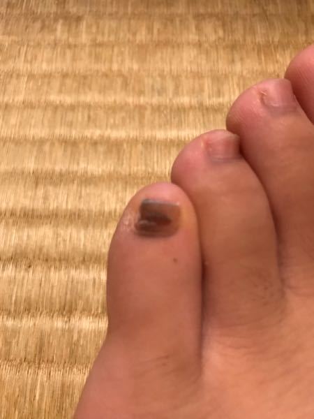 写真あります 足の小指にほくろの様なものがあります 結構幼い頃から小指が黒い Yahoo 知恵袋