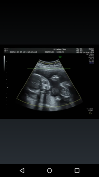 21週の赤ちゃんの正面のエコー写真です 先生に女の子って言われましたが 女の Yahoo 知恵袋
