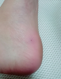 虫刺されの黒い点が残って消えません 一週間前に川でbbqをしたのですが 両足 Yahoo 知恵袋