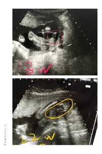 18週と22週のエコーです 18週の時に男の子かもと言われ 22週の時に女の Yahoo 知恵袋