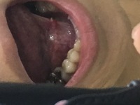 舌小帯にできた白いできものについて 舌小帯のところに 小さなニキビ Yahoo 知恵袋