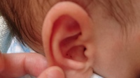 4ヶ月の赤ちゃんの耳の中にかさぶたのようなものができていました Yahoo 知恵袋