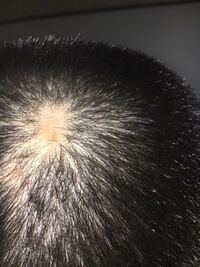 これってもう生えてこないですよね 抜毛症です Yahoo 知恵袋