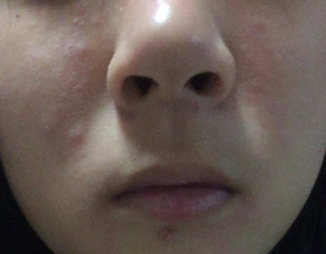 脂漏性皮膚炎の症状について。先月、脂漏性皮膚炎と診断されました 