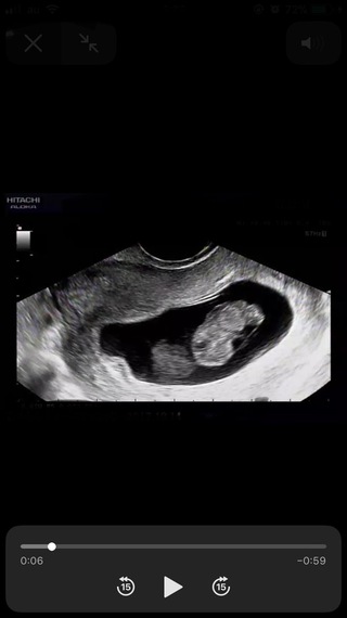 妊娠8週目エコー画像について妊娠8週目で心拍の確認も出来ています Yahoo 知恵袋