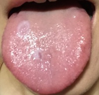 舌の表面に白いできものが2ヶ所あり 気になっています 2ヶ月くらい経過 1ヶ Yahoo 知恵袋