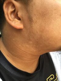 海で日焼けして皮がむけてきたんですけど皮がむけてるのに日サロで焼い Yahoo 知恵袋