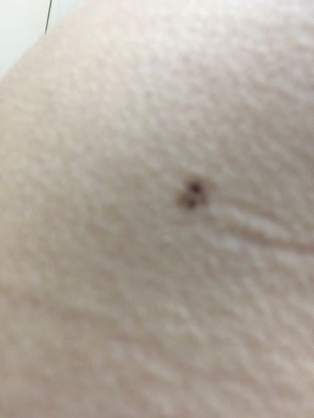 メラノーマ 脇腹 に関するq A Yahoo 知恵袋