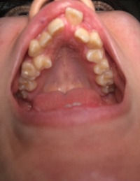 前歯の部分矯正をしたい女子高生です 噛み合わせの問題などが出てくることはわか Yahoo 知恵袋