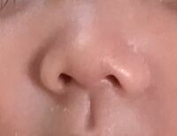 赤ちゃんの鼻を矯正する道具ってあるの タイトルの通りです生後2ヶ月の娘なん Yahoo 知恵袋