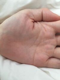 太陽環でしょうか 右手の薬指の爪に白い点ができたので ふと掌も Yahoo 知恵袋