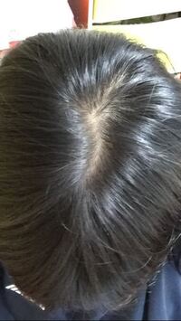 はげてますか 中学生でも使える育毛剤を教えてください つむじ Yahoo 知恵袋