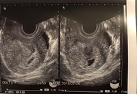 胎嚢確認後の流産についてです 現在 妊娠週数5w前後 前回の排卵日 Yahoo 知恵袋