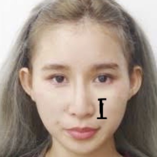 こんにちは小鼻の縦幅が長く 真剣に悩んでいます切って縮めることはできませんか Yahoo 知恵袋