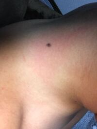 これってホクロですか 時々触ったら痛いんです ホクロに似た皮膚癌のメラ Yahoo 知恵袋