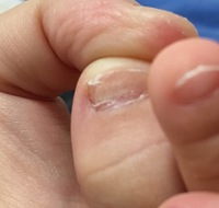 子供の足の爪について 1歳8ヶ月の子です 先程爪を切っていた時に気 Yahoo 知恵袋