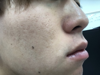 21歳の男です ニキビ跡のクレーターとか毛穴がやばいです 中学生の Yahoo 知恵袋