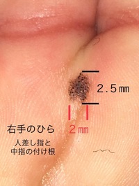 赤ちゃんの手の甲に黒い点 １０ヶ月の赤ちゃんですが 今見たら手 Yahoo 知恵袋