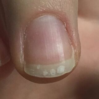 中指の爪に白い斑点が4 5個出来ました 何かの病気の予兆ですか ピン Yahoo 知恵袋