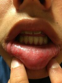 下唇がおかしいです。 舌で触った感じはザラザラしています
なんかの病気でしょうか。
とても心配です。