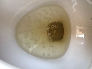 閲覧注意 この尿の色 泡は健康上問題ありますか 高校生1年 男子 Yahoo 知恵袋