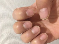 私は生まれつき 爪がとてつもなく弱いです 壁とかにちょっと爪 Yahoo 知恵袋