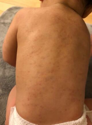 一歳2ヶ月の息子の背中に シミのような茶色の小さい斑点が一ヶ月の間 Yahoo 知恵袋