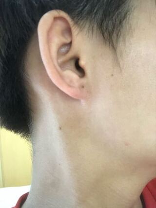耳たぶに黒いホクロのようなものができて それを触ってみると皮膚の中にしこ Yahoo 知恵袋