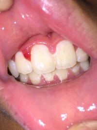 昼寝をして眼を覚ますと突然歯茎に赤いデキモノができていました Yahoo 知恵袋