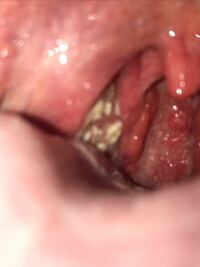 出来 物 白い 喉 喉に白い斑点ができる5つの原因と対処法！