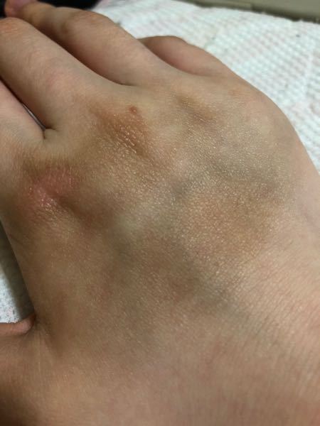 4月の初め頃にやけどをしました 直後は痛みもひどく大変でした Yahoo 知恵袋