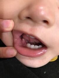 1歳半の息子の奥歯が生えてくるようで生えてくる場所が腫れてたのです Yahoo 知恵袋