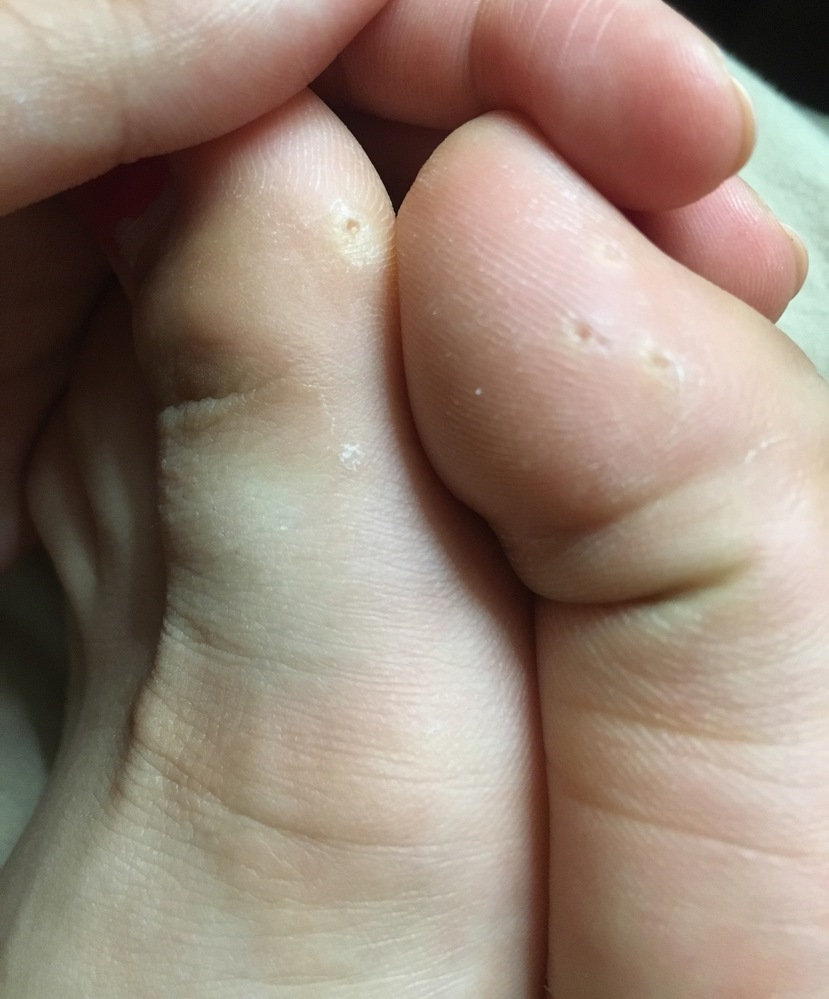 むける 皮 が 頭皮 の