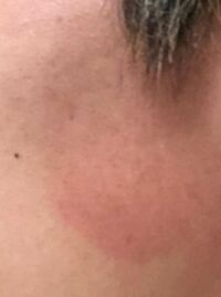 溶接の仕事をしていて 写真のように顔を日焼けするのですが 少し上の方にあざみ Yahoo 知恵袋