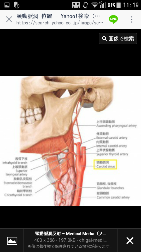 頸動脈洞反射ってどうやったらなりますか 頸動脈洞って写真だと首の Yahoo 知恵袋