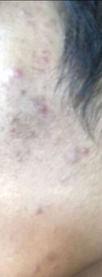 このニキビどう治すんですか 触るとゴツゴツしてた嫌です 15歳なん Yahoo 知恵袋