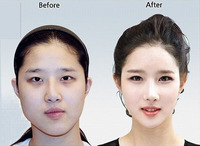 韓国人は歯列矯正のように若い時から顔を整形手術で整えるのでしょうか 日本だと Yahoo 知恵袋