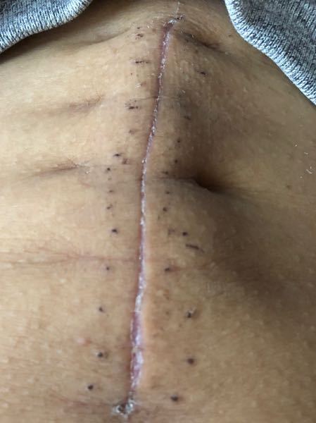 帝王切開の傷写メあり 帝王切開して10日ちょっとです 写真の Yahoo 知恵袋