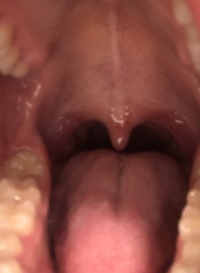 閲覧注意 この喉ちんこは正常でしょうか 最近声が詰まる 喋るとガラガラ声にな Yahoo 知恵袋