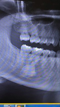 歯の一部が欠けたため１０年ぶりに歯医者へ行きました レントゲンを撮ったのです Yahoo 知恵袋