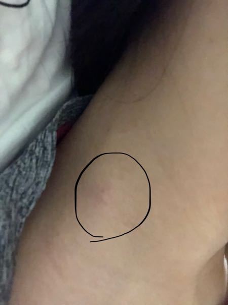 右側の首にしこり？の様なものができました。 - これってなんでしょう 