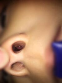 3歳半の子供の鼻の中を良く見てみると 腫れ てます 片方のみ 今現在 Yahoo 知恵袋