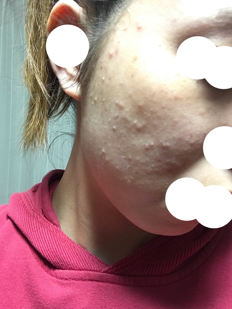 皮膚の病気 アトピー 解決済みの質問 Yahoo 知恵袋