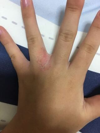 今 指と指の間が荒れてて 痒かったり乾燥で切れて血が出ることがあります Yahoo 知恵袋